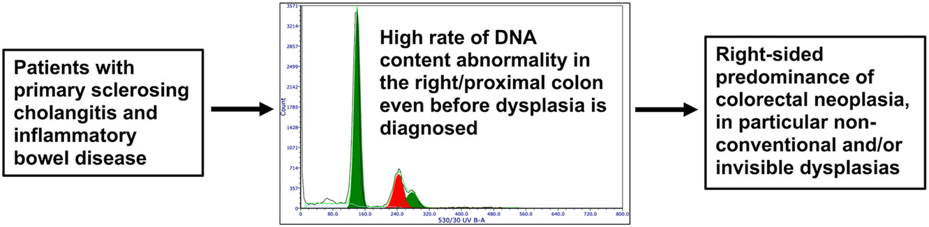 DNA content abnormality frequently develops in the right/proximal colon in patients with primary sclerosing cholangitis and inflammatory bowel disease and is highly predictive of subsequent detection of dysplasia