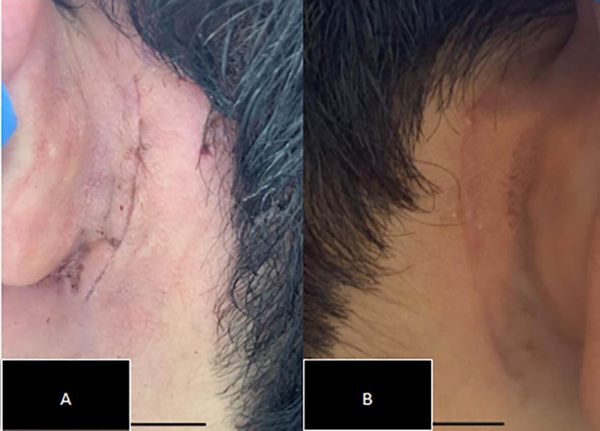 Octyl-2-cyanoacrylate Tissue Adhesive Closure Versus Subcuticular Suture for Post-Auricular Incisions