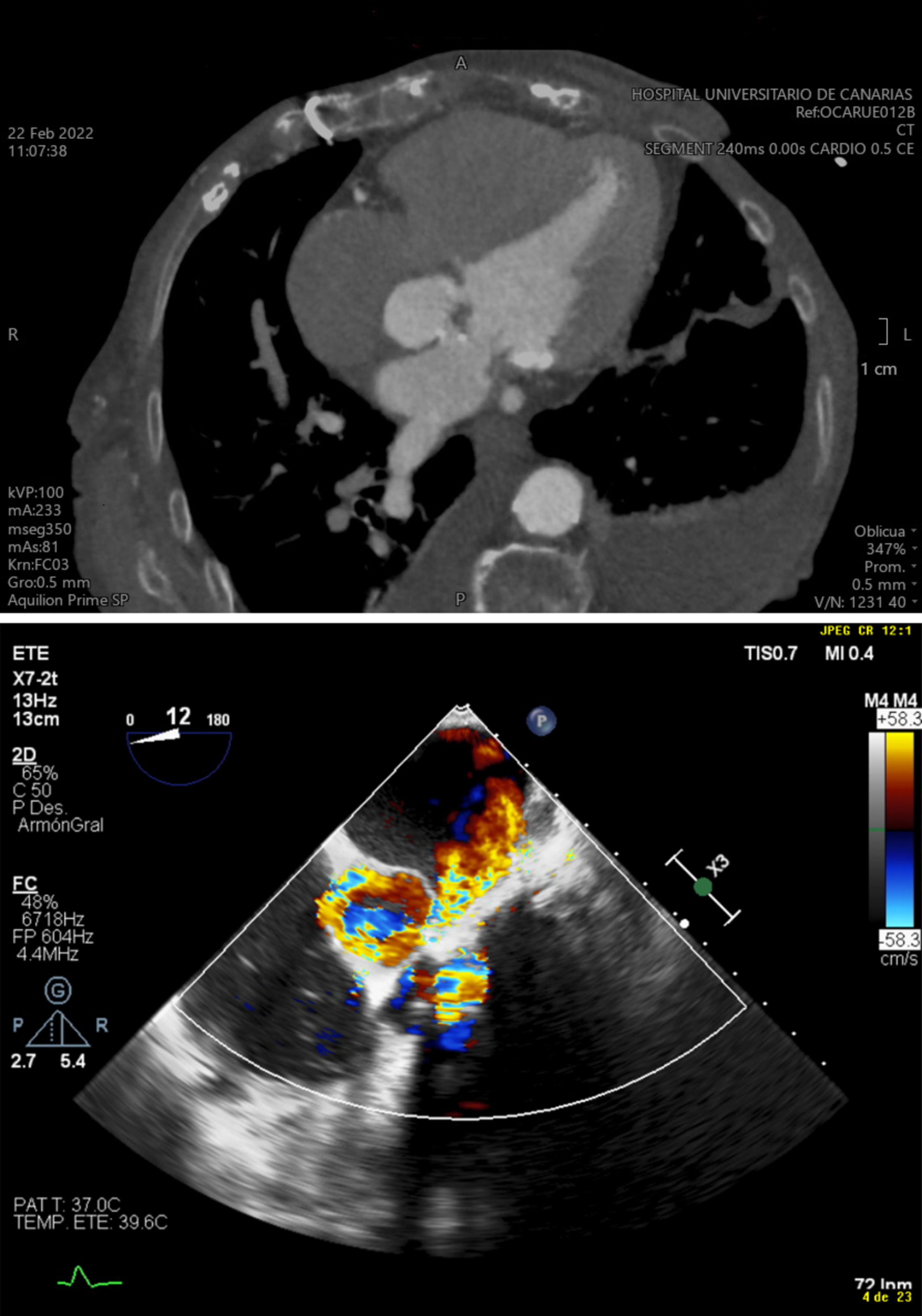 Interatrial septum dissection, severe aortic stenosis, and paravalvular mitral regurgitation: A rare combination and their hemodynamic interrelationship