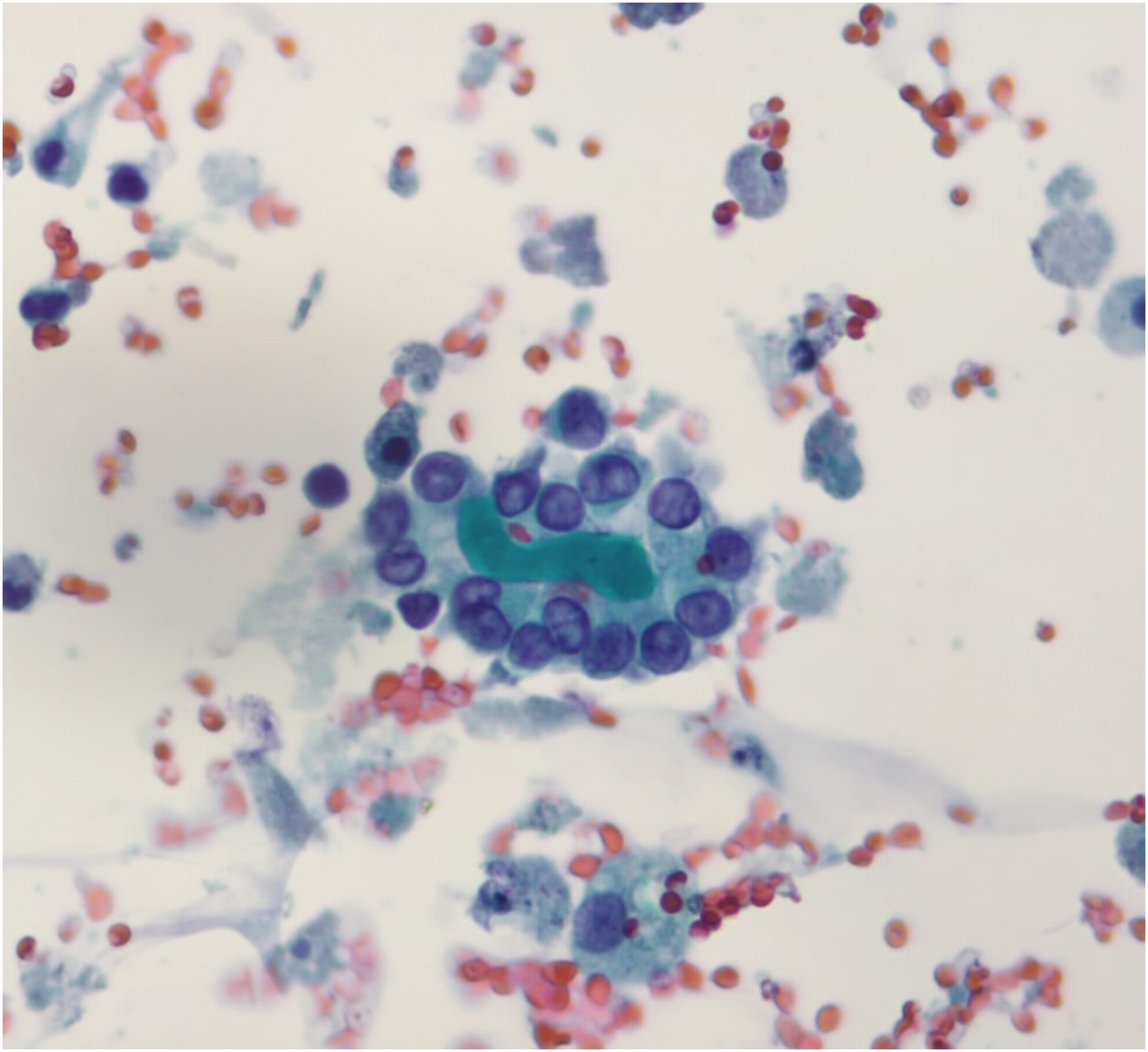 Incidental finding in urine cytology in a patient with chronic renal disease