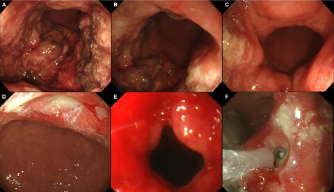 Complications and outcomes in diffuse large B-cell lymphoma with gastric lesions treated with R-CHOP