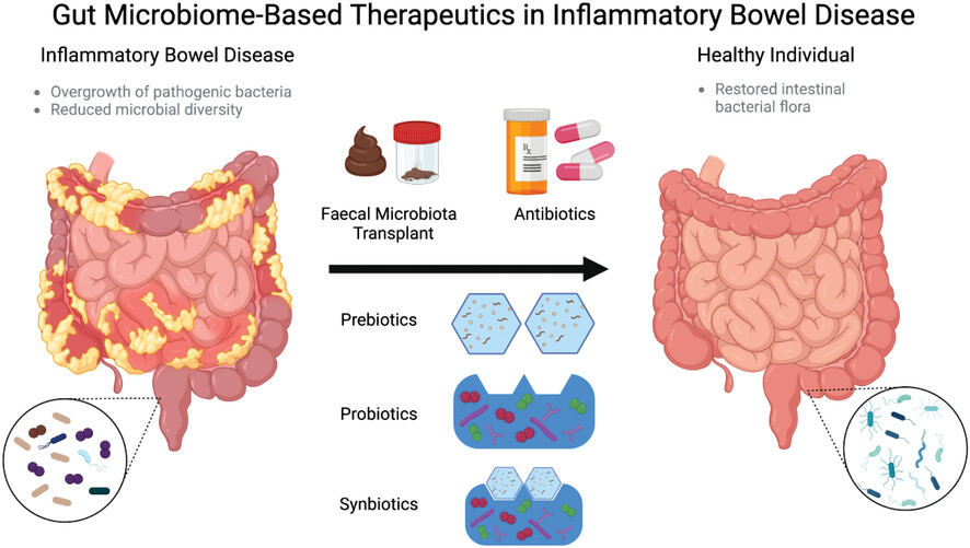 Gut microbiome–based therapeutics in inflammatory bowel disease