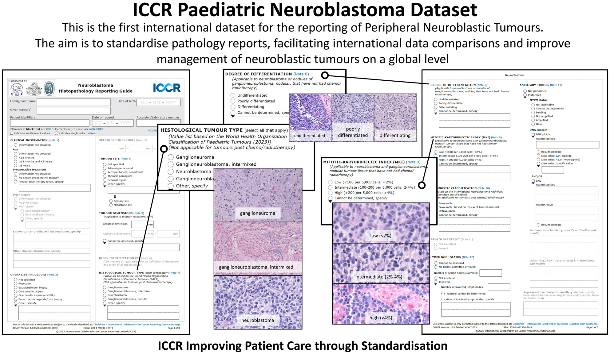 Data set for reporting of peripheral neuroblastic tumours: recommendations from the international collaboration on cancer reporting (ICCR)