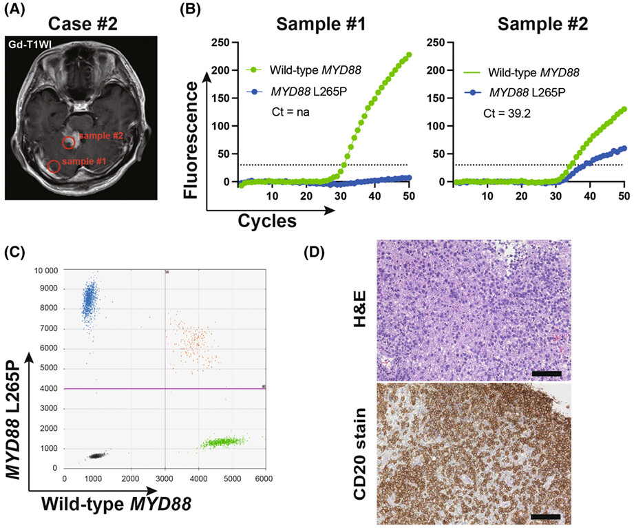 Rapid detection of the MYD88 L265P mutation for pre- and intra-operative diagnosis of primary central nervous system lymphoma