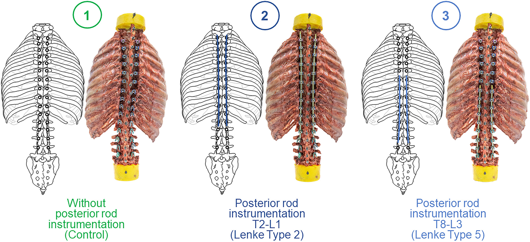 Scoliosis instrumentation alters primary and coupled motions of the spine: An in vitro study using entire thoracolumbar spine and rib cage specimens