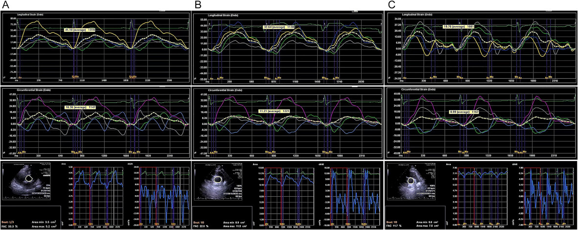 Impaired Aortic Biomechanical Properties in Patients With Severe Obstructive Sleep Apnea Syndrome