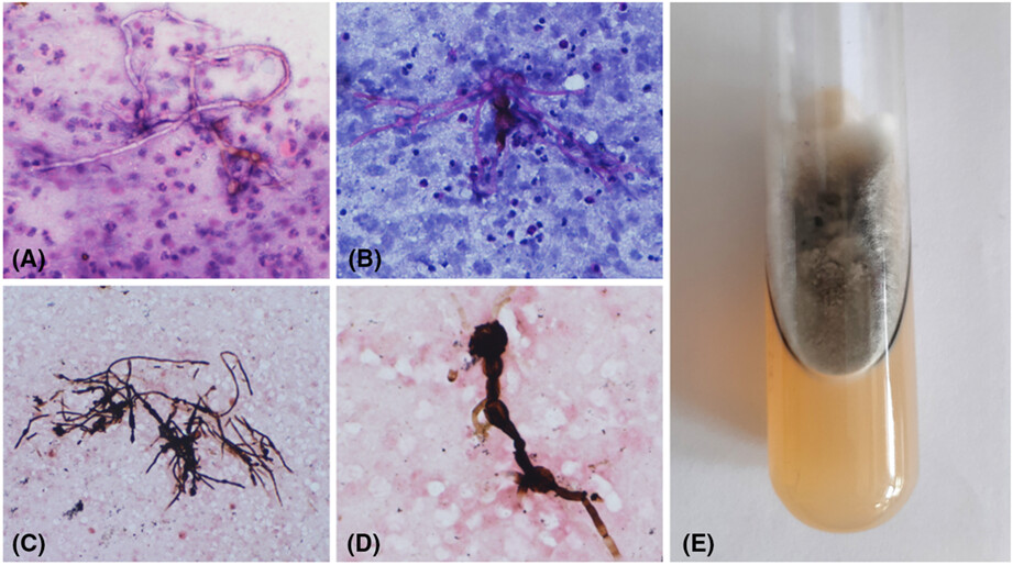 Not all black fungus is mucormycosis: A challenging case of Medicopsis romeroi
