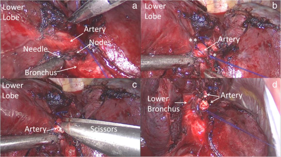 Handling benign interlobar lymphadenopathy during thoracoscopic lobectomy