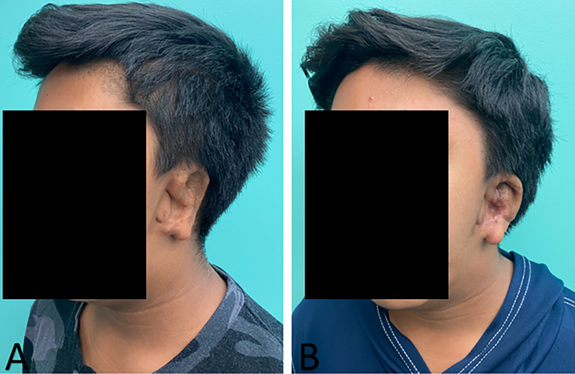 Salvage of Infected Alloplastic Ear Reconstructions via Negative Pressure Wound Therapy