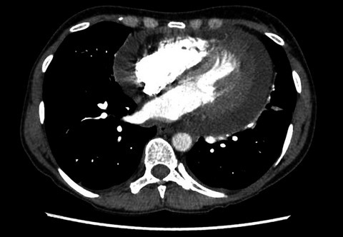 Metastatic ductal adenocarcinoma of the breast presenting with pericardial effusion—Challenges in the diagnosis of breast cancer