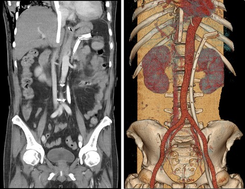 Complication of venovenous extracorporeal membrane oxygenation cannulation – the significance of an inferior vena cava anomaly