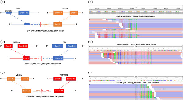 Identification of novel somatic fusions of ERG-VEGFA, TMPRSS2-ERG, and VEGFA-TMPRSS2 in prostate cancer treated with anlotinib and androgen deprivation therapy: A case report