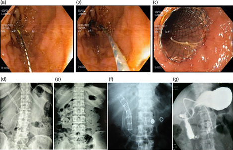 Palliation of malignant gastroduodenal obstruction with self-expandable metal stent using side- and forward-viewing endoscope: Feasibility and outcome