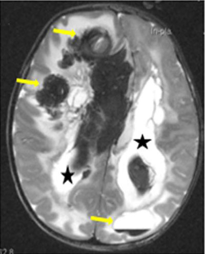 Delineation of the Clinical, Molecular and Cellular Aspects of Novel JAM3 Mutations Underlying the Autosomal Recessive Hemorrhagic Destruction of the Brain, Subependymal Calcification, and Congenital Cataracts