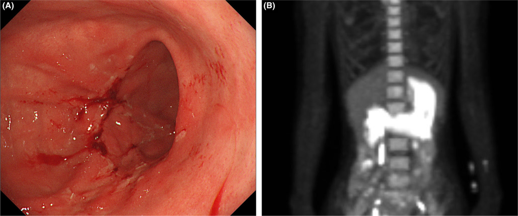 Refractory gastroduodenal ulcers: A rare complication with Bloom syndrome