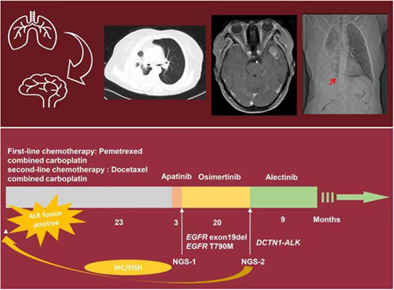 Effectiveness of alectinib and osimertinib in a brain metastasized lung adenocarcinoma patient with concurrent EGFR mutations and DCTN1-ALK fusion