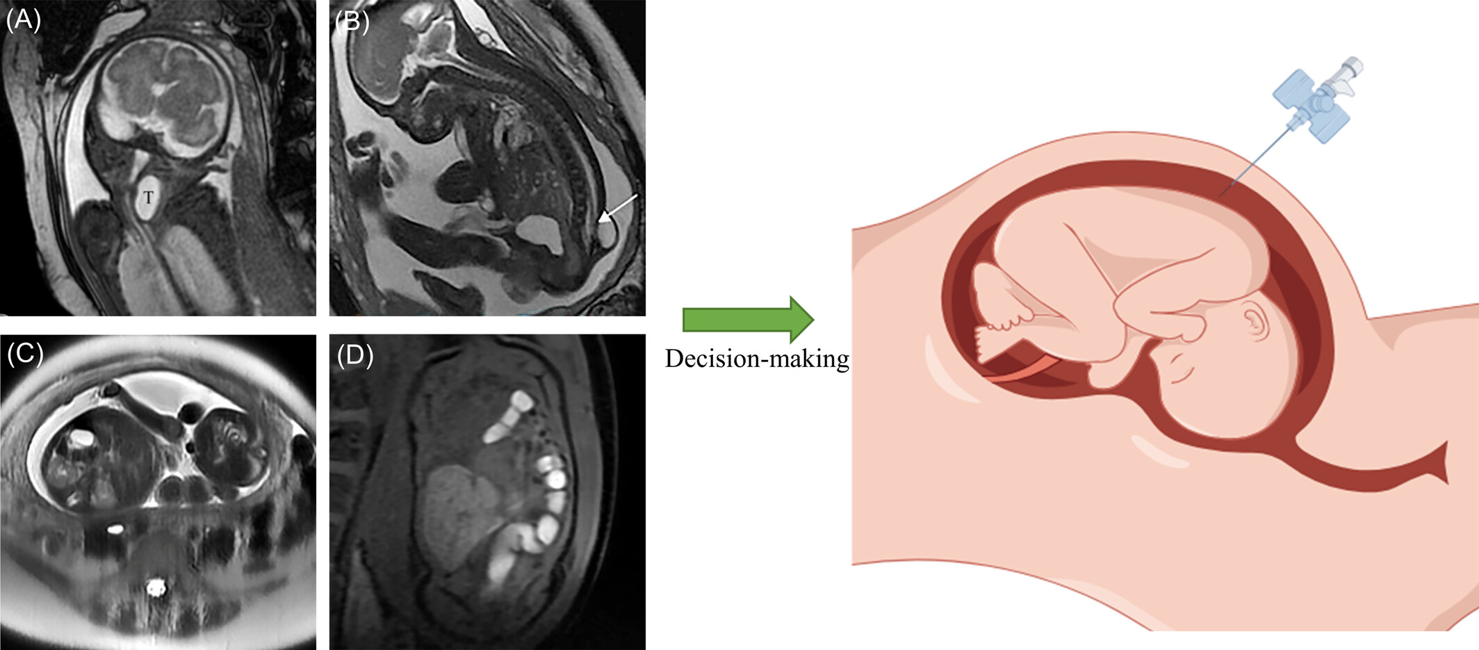 Utilization of MRI in Fetal Surgery