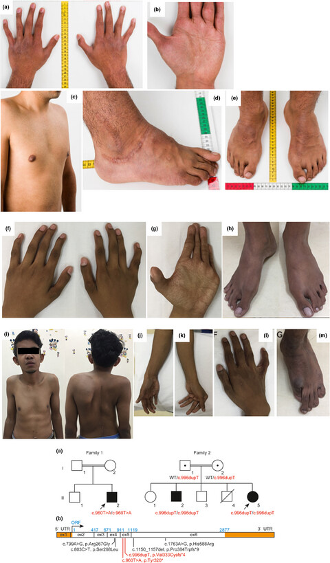 Delineation of musculocontractural Ehlers–Danlos Syndrome caused by dermatan sulfate epimerase deficiency