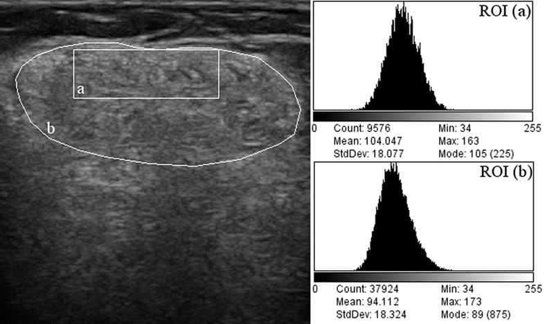 Effect of beam attenuation on muscle ultrasound echogenicity measurement in muscular dystrophies