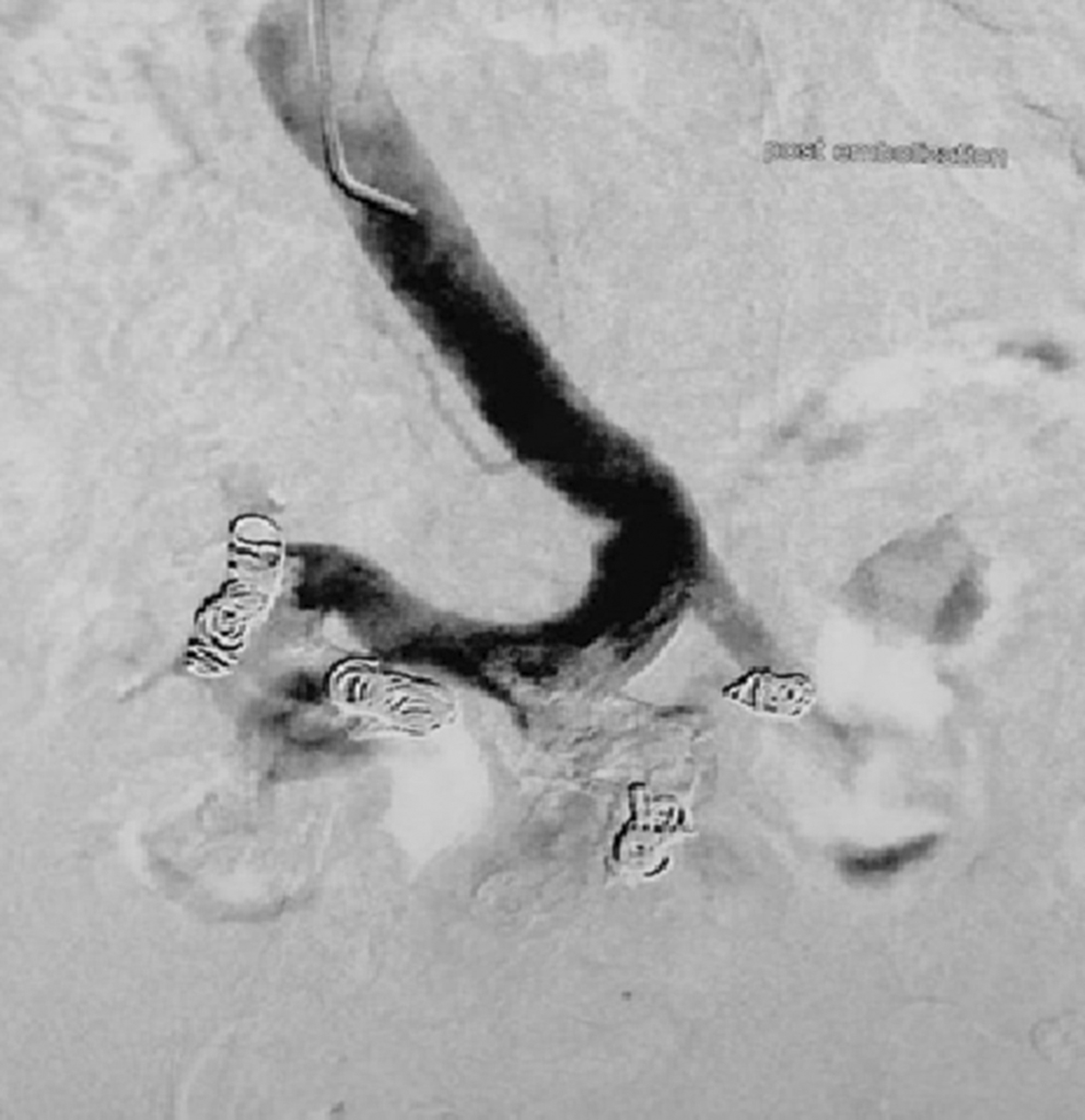 Massive hematochezia due to jejunal varices successfully treated with coil embolization