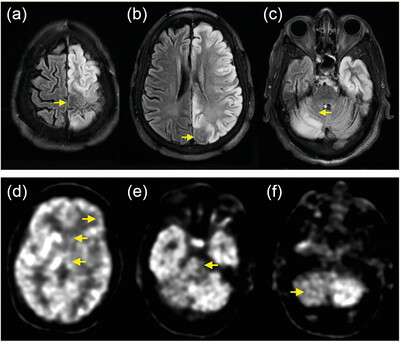 Diaschisis in the human brain reveals specificity of cerebrocerebellar connections