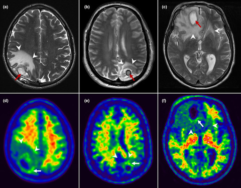 β-Amyloid may accumulate in the human brain after focal bacterial infection: An 18F-flutemetamol positron emission tomography study