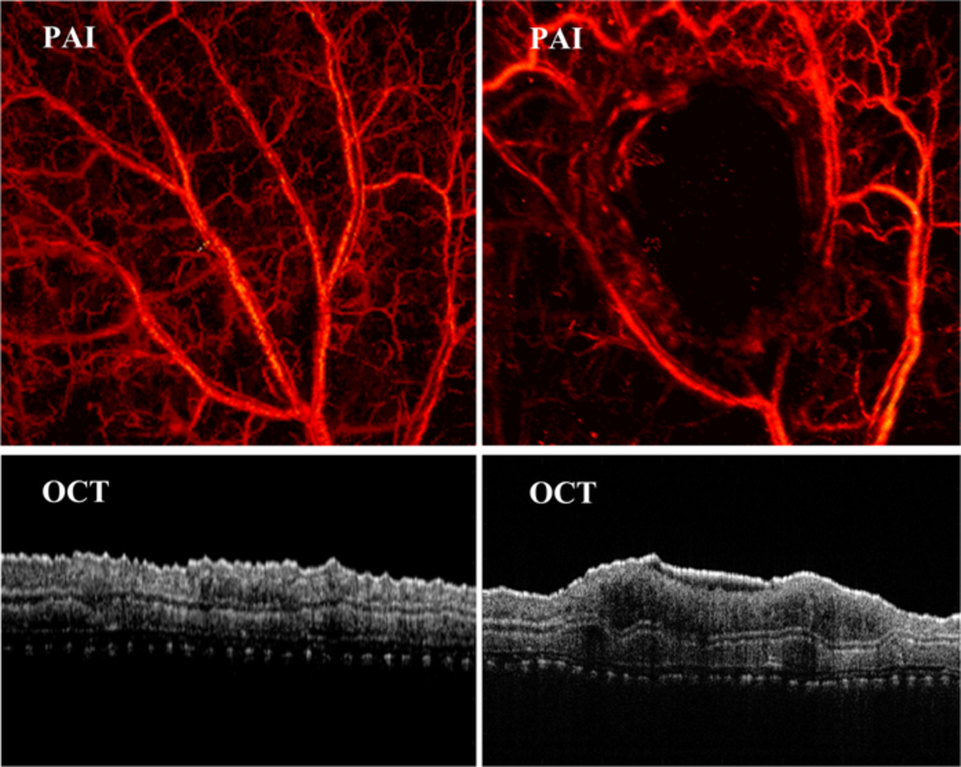 Towards quantitative assessment of burn based on photoacoustic and optical coherence tomography