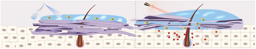 Controlled Delivery of MTX from Thermosensitive Hydrogels Using Au Nanorods for Enhanced Therapeutics of Psoriasis via Improving Stratum Corneum Penetration