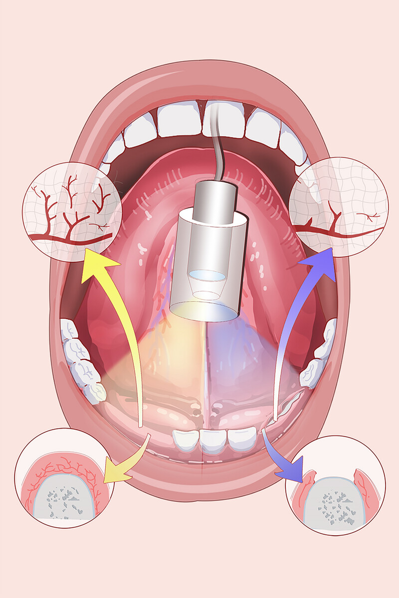 Antiangiogenic Medications Impede the Oral Mucosal Microcirculation and Interfere with Oral Wound Healing: A Complication Deserving of Attention