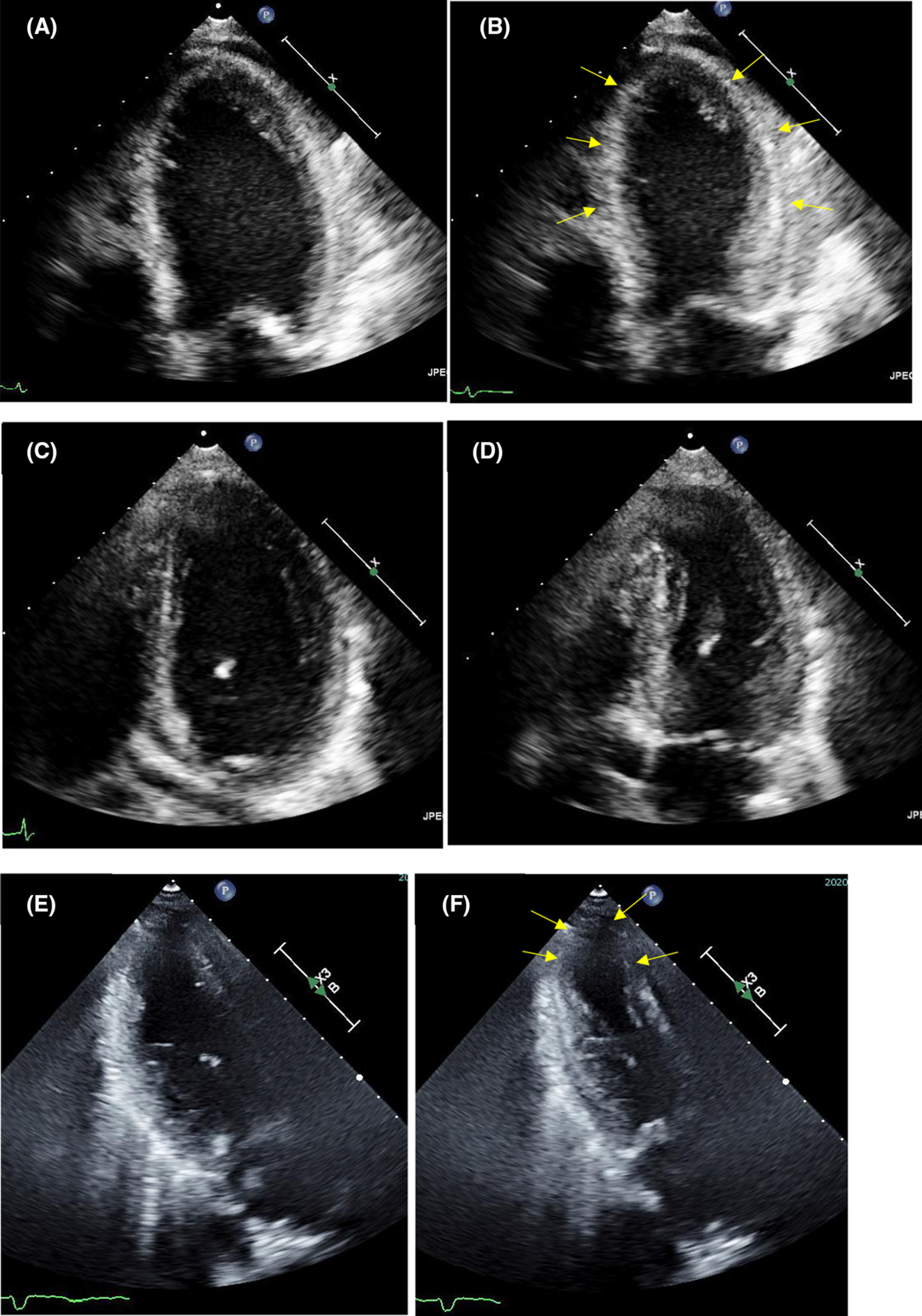 Reoccurrence of takotsubo cardiomyopathy induced by osimertinib: A case report