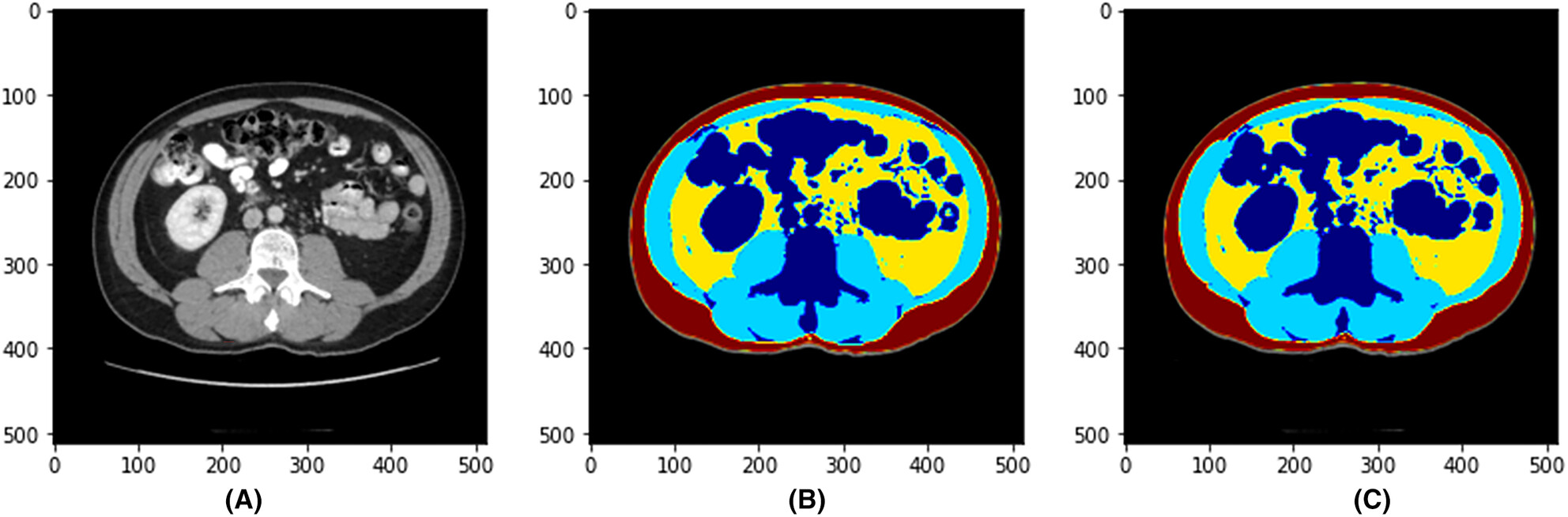 Using a new artificial intelligence-aided method to assess body composition CT segmentation in colorectal cancer patients
