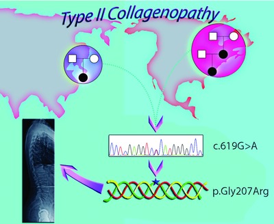 Novel COL2A1 Variant (c.619G>A, p.Gly207Arg) Manifesting as a Phenotype Similar to Progressive Pseudorheumatoid Dysplasia and Spondyloepiphyseal Dysplasia, Stanescu Type