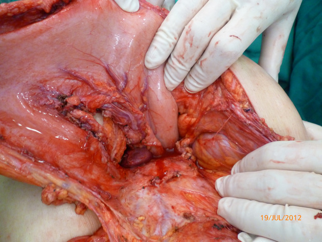 Gastrointestinal stromal tumor (GIST) mistaken for pancreatic pseudocyst – case report and literature review