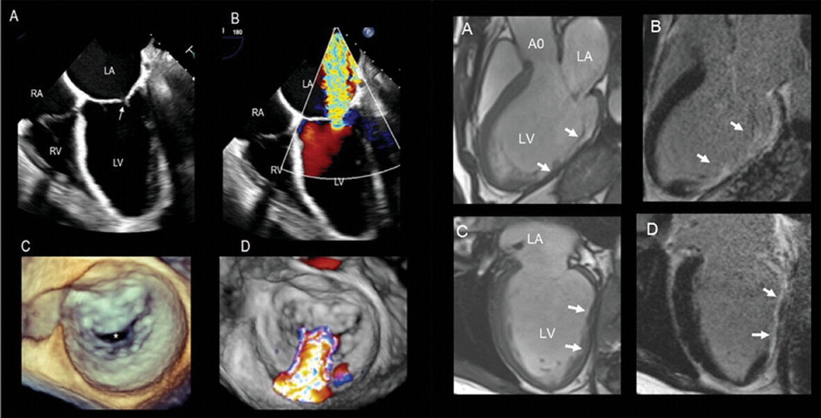 Functional Mitral Valve Regurgitation, Pathophysiology, Leaflet ReModeling, and the Role of Imaging