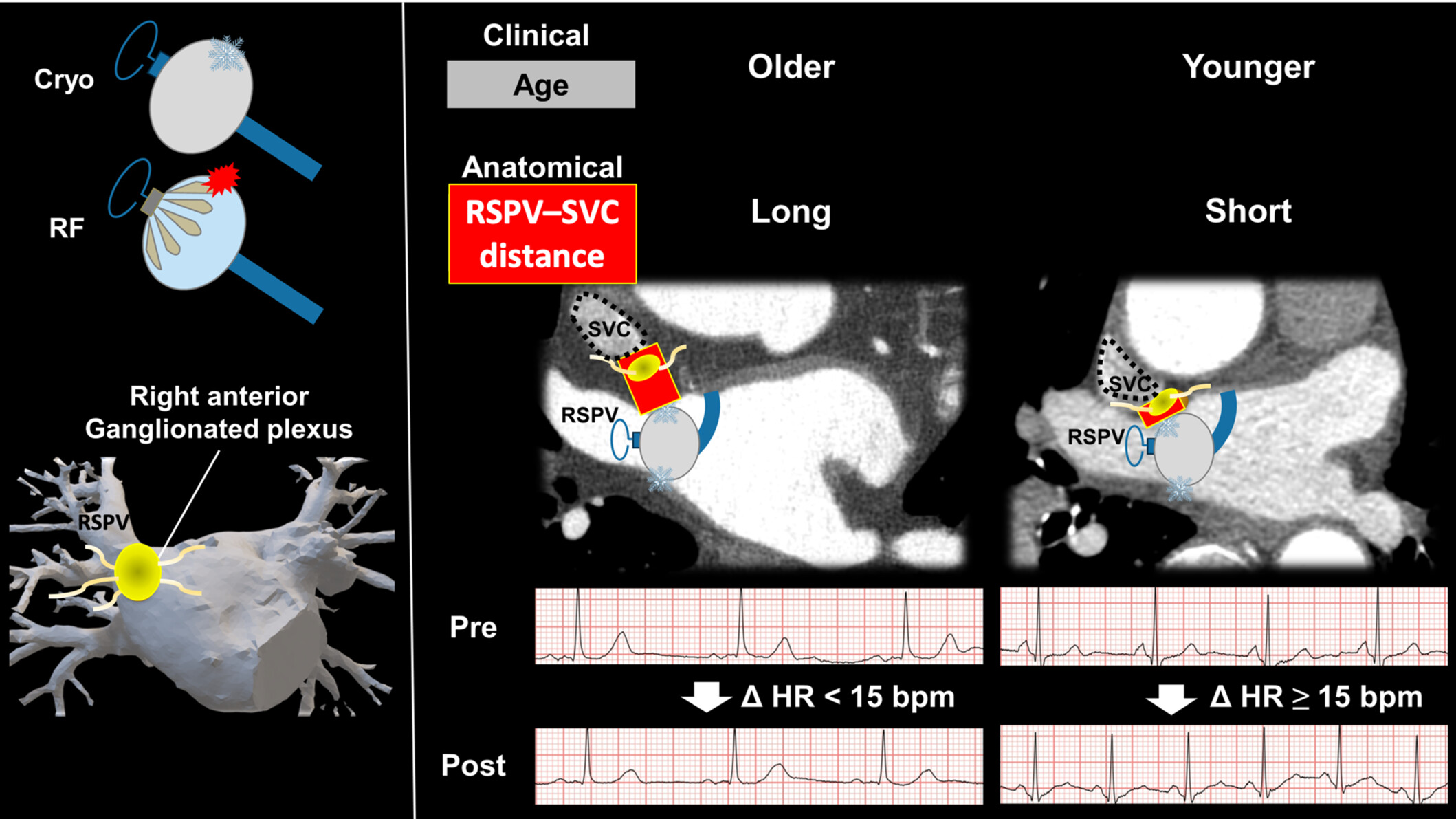 Distance-dependent neuromodulation effect during thermal ablation for atrial fibrillation