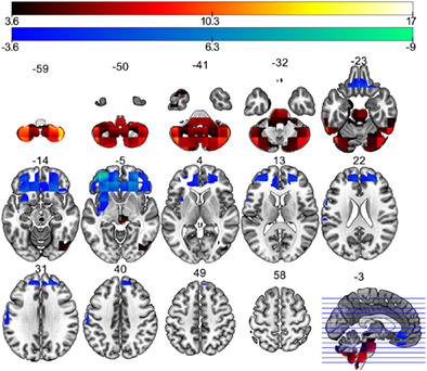 Sex differences in predictors and regional patterns of brain age gap estimates