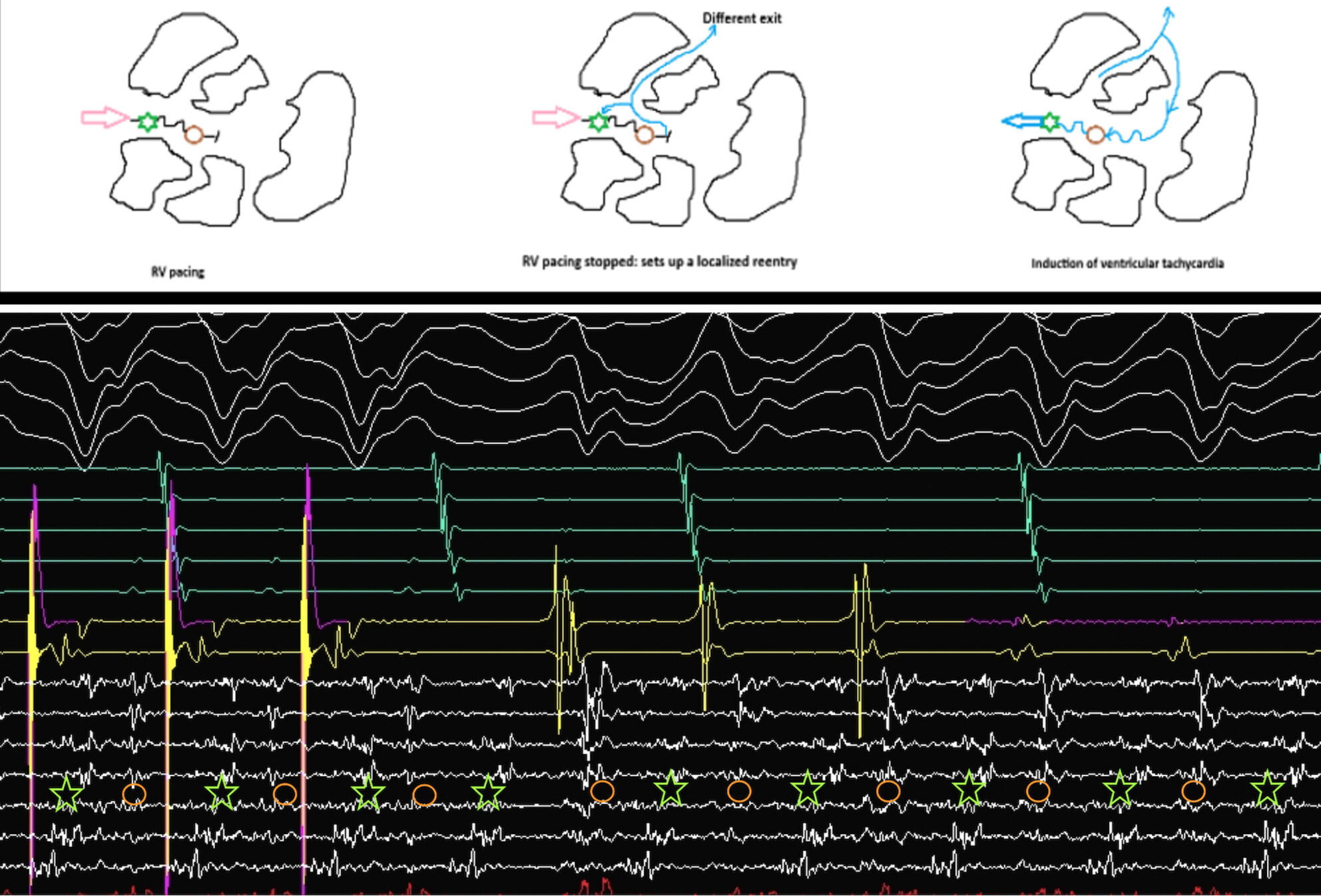 Managing a ventricular tachycardia storm: Looking beyond the horizon