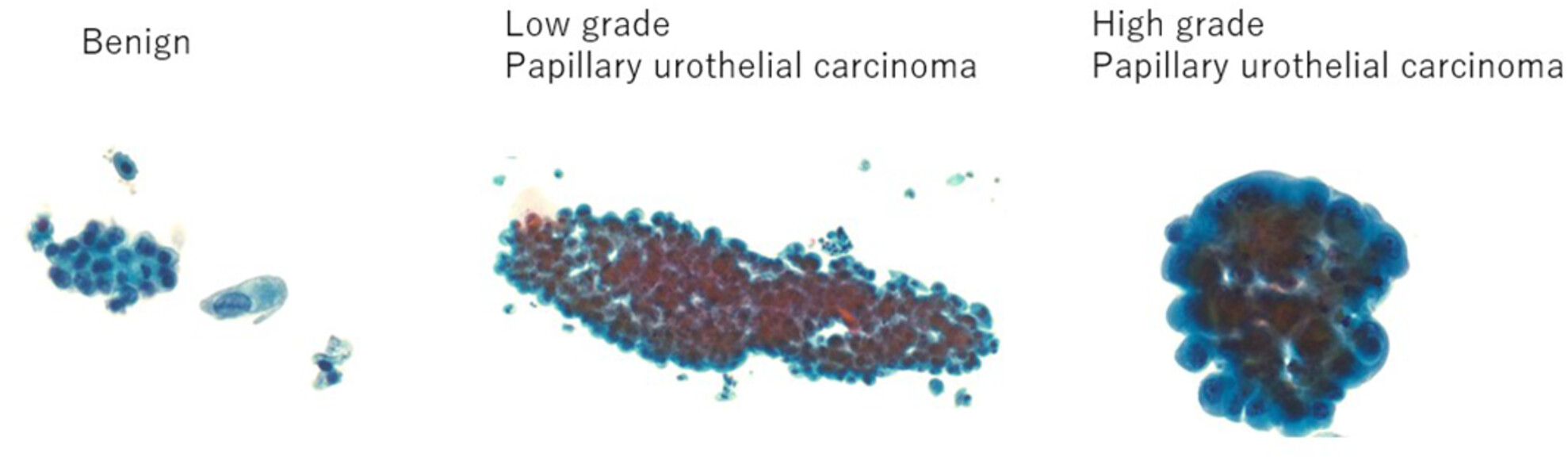 Cytomorphological characteristics of low-grade papillary urothelial carcinoma in voided urine samples: Distinction from benign and high-grade papillary urothelial carcinoma