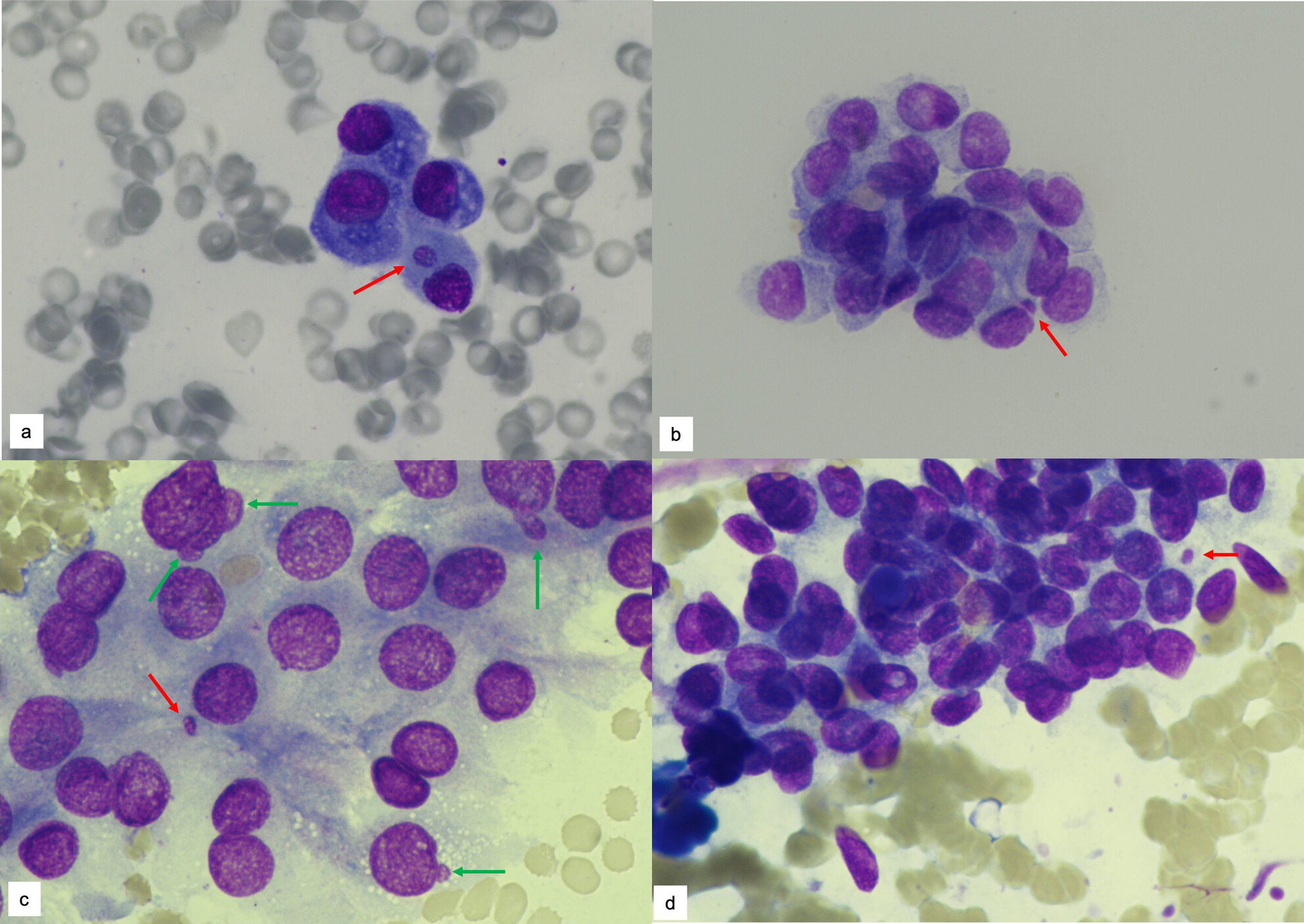 Micronucleus and Nuclear Budding Help to Identify Malignancy in Thyroid Fine Needle Aspiration Cytology