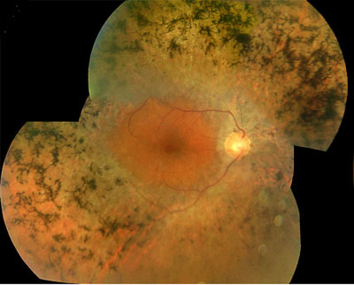 RP1L1 Variants are Associated with a Spectrum of Inherited Retinal Diseases Including Retinitis Pigmentosa and Occult Macular Dystrophy