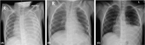 Recurrent hydrothorax in a child on peritoneal dialysis: A case report and review of the literature
