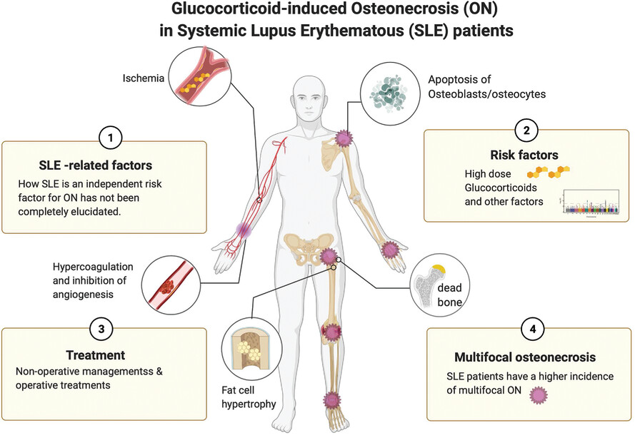 Glucocorticoid-induced osteonecrosis in systemic lupus erythematosus patients