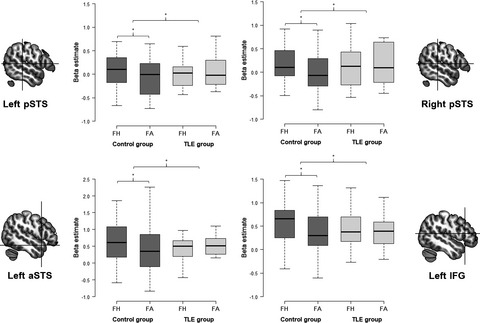 Temporal lobe epilepsy alters neural responses to human and avatar facial expressions in the face perception network