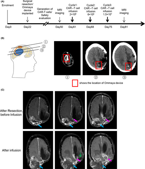 Bioactivity and safety of B7-H3-targeted chimeric antigen receptor T cells against anaplastic meningioma