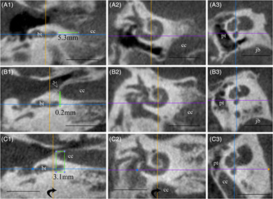 Impact of occlusive material and cochlea-carotid artery relation on eustachian tube occlusion in subtotal petrosectomy