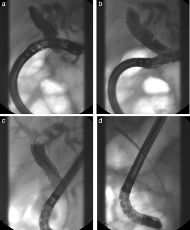 Long-scope position insertion for a challenging bile duct access by a novel digital single-operator cholangioscope (SpyGlass DS) in periampullary diverticulum