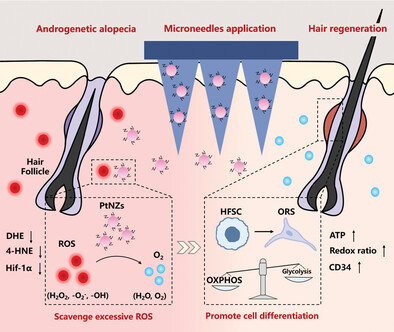 Platinum Nanozyme-Loaded Dissolving Microneedles Scavenge ROS and Promote Lineage Progression for Androgenetic Alopecia Treatment