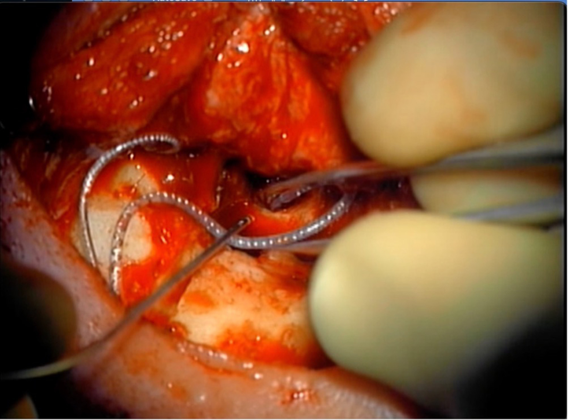 The use of a simultaneous fascia lata-free flap with cochlear implantation after radical Mastoidectomy