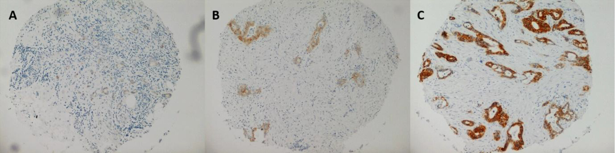 FXYD3 Is Frequently Expressed in Pancreatic Ductal Adenocarcinoma but Does Not Predict Survival