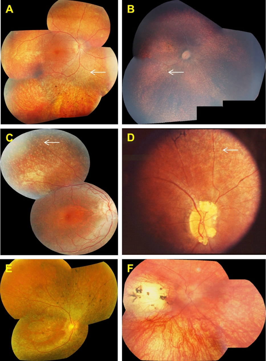 Screening of a Large Cohort of Leber Congenital Amaurosis and Retinitis Pigmentosa Patients Identifies Novel LCA5 Mutations and New Genotype–Phenotype Correlations